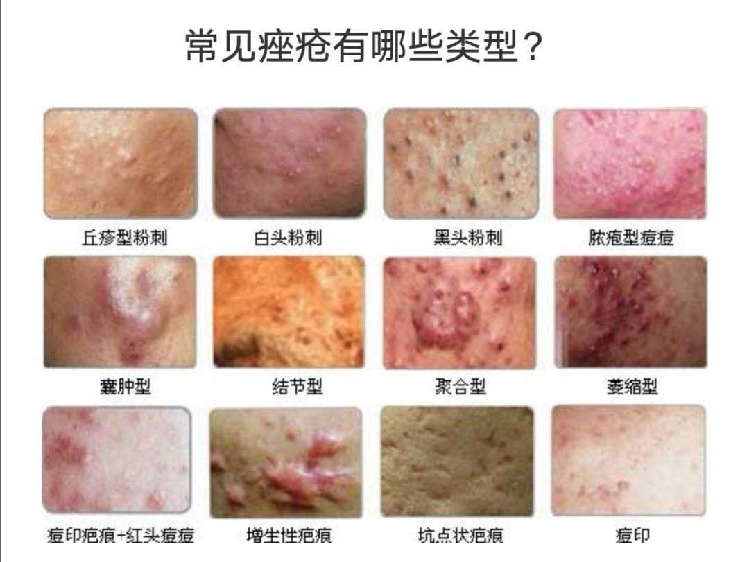 脸上长痘痘怎么快速祛痘?