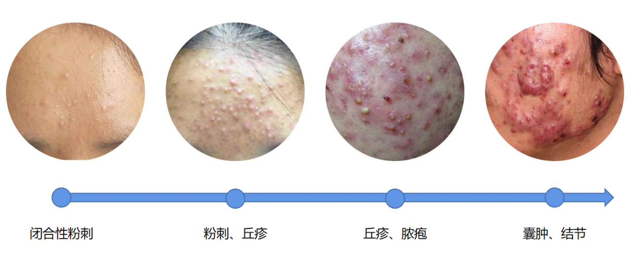 脸上长痘痘怎么快速祛痘?