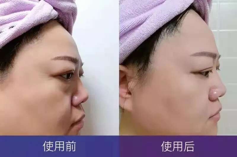 护肤心得|怎么祛除抬头纹?方法真的就这么简单