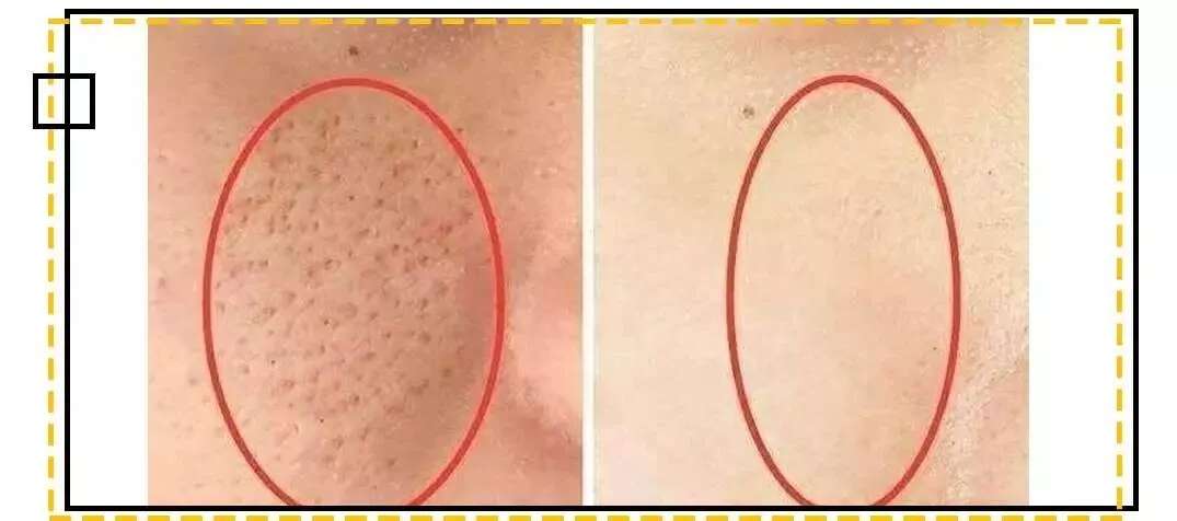 皮肤八大现象(二)丨毛孔粗大要怎么解决?