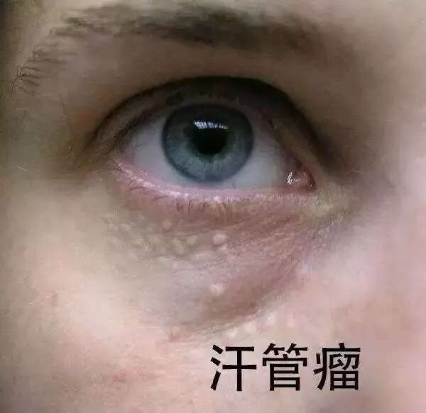 皮肤八大现象(七)丨“眼部衰老”的正确护理方法?