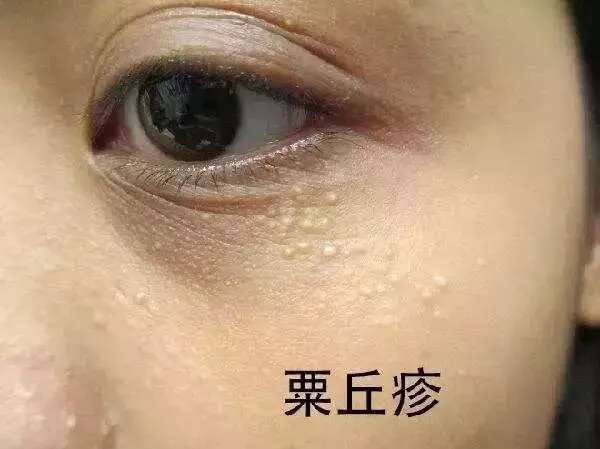 皮肤八大现象(七)丨“眼部衰老”的正确护理方法?