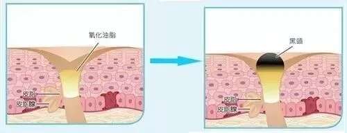 皮肤八大现象(八)丨“黑头、白头粉刺”的正确应对方法!