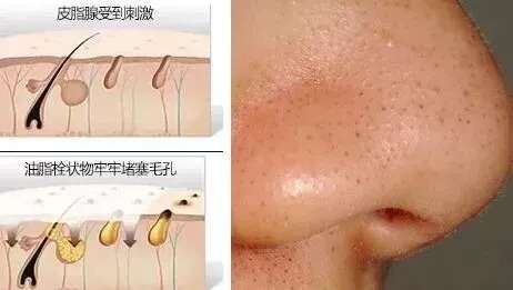 皮肤八大现象(八)丨“黑头、白头粉刺”的正确应对方法!