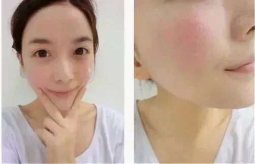 皮肤八大现象(八)丨“黑头、白头粉刺”的正确应对方法!