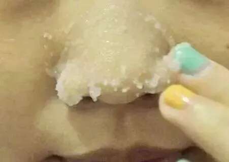 皮肤八大现象(八)丨“黑头、白头粉刺”的正确应对方法!
