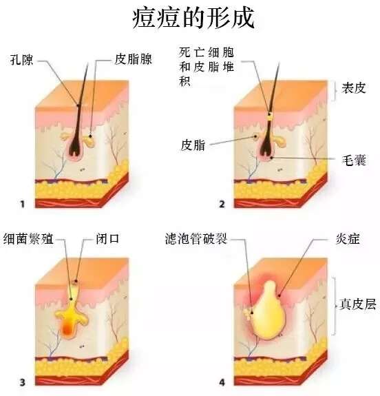 怎么祛痘?认清痘痘形成原因,别再信想祛痘先除螨的鬼话!
