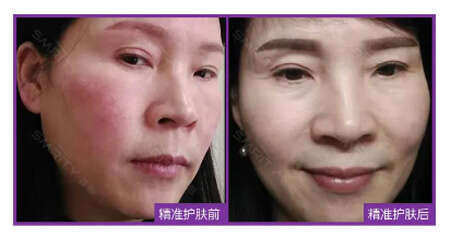 敏感肌肤用什么护肤品?运用精准护肤方案修复敏感肌
