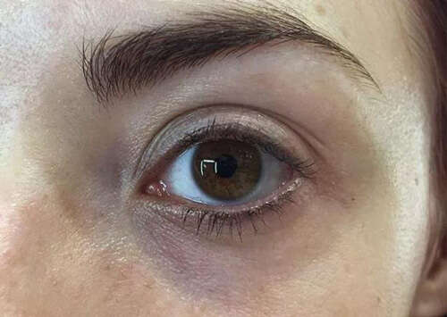黑眼圈很重怎么去除?不同类型的黑眼圈护肤技巧