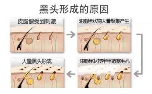 怎么去黑头?去黑头小妙招