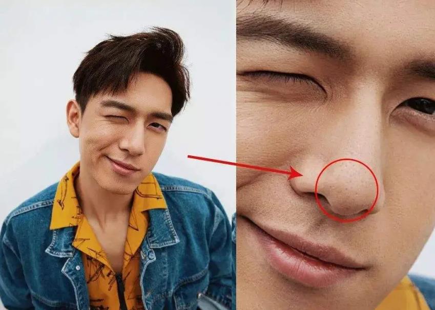 鼻子毛孔粗大有洞红红的鼻头黑头草莓鼻怎么去除?