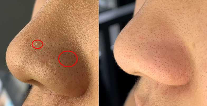 鼻子毛孔粗大有洞红红的鼻头黑头草莓鼻怎么去除?