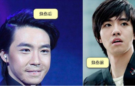 俞灏明23岁毁容、被公司放弃、好友背叛,他蛰伏五年,如今成了人生赢家
