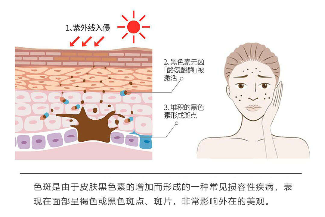 脸上长斑的原因是什么?为什么黑色素顽固沉积?