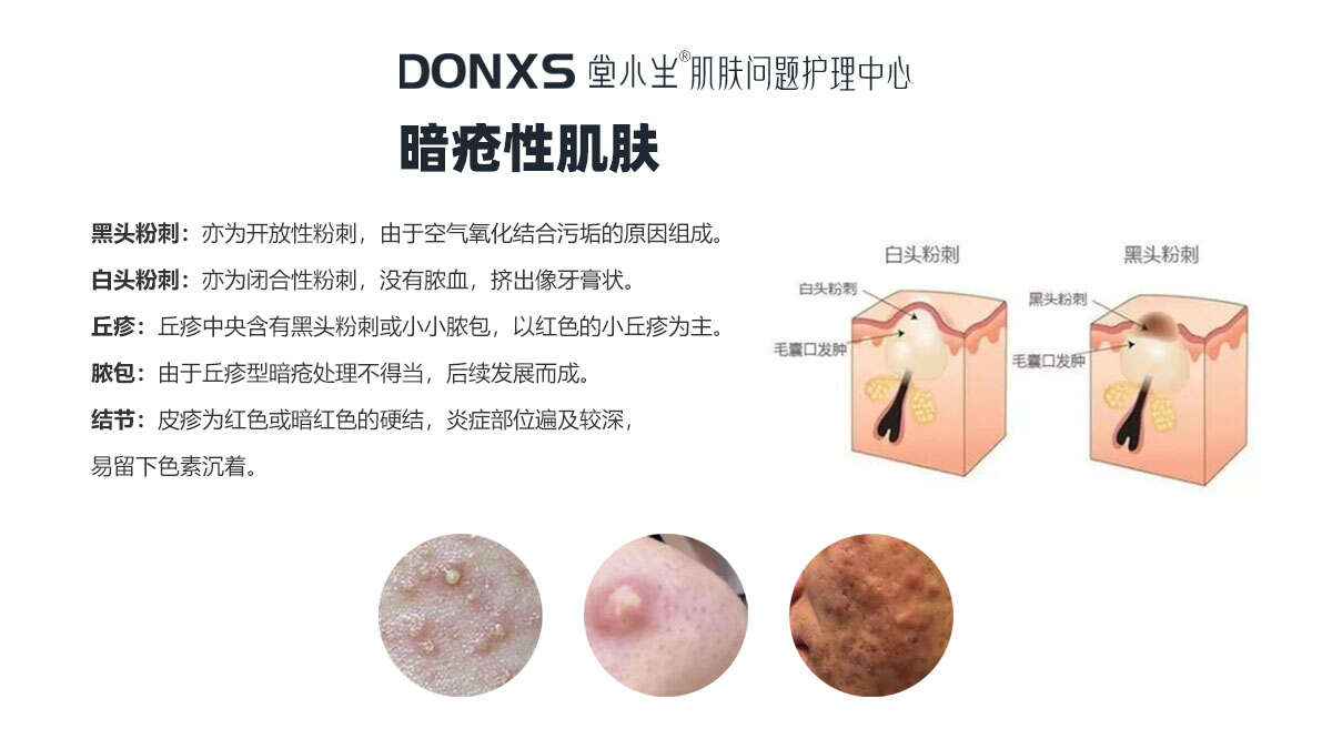 脸上长痘痘不能吃的四种食物