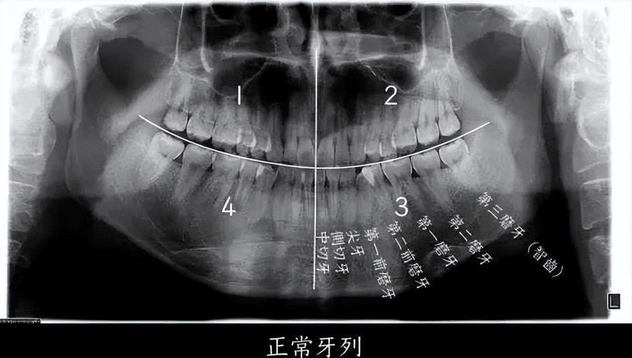 小伙拔智齿后晕倒,开颅手术14天后去世!网友担心:还能拔吗?